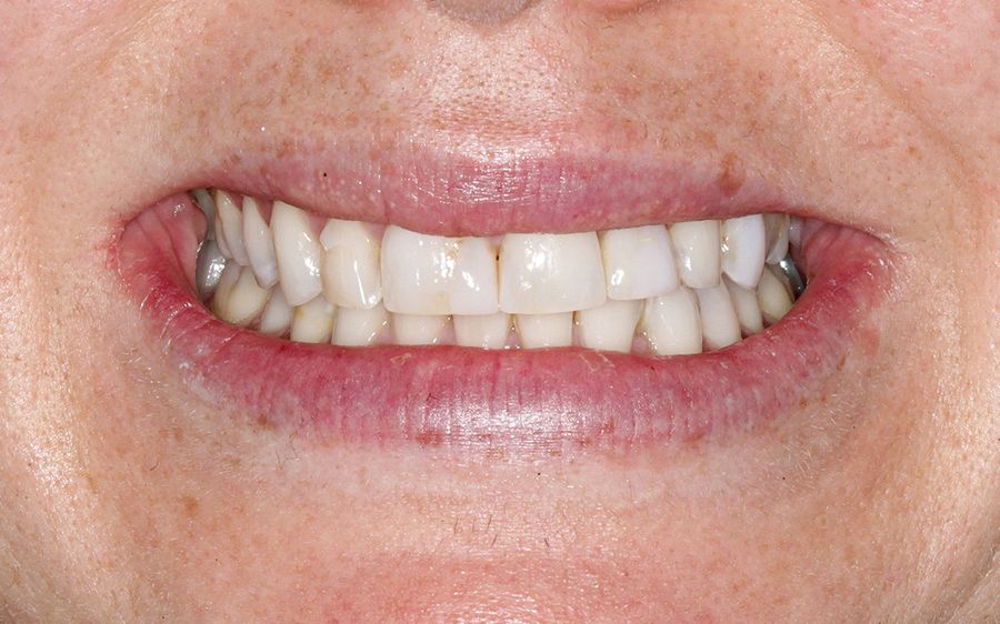 composite veneers before - 3dental